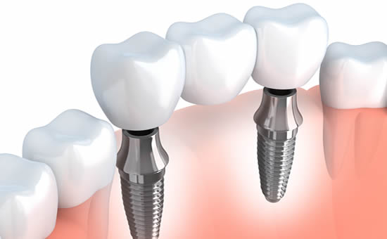 Two implants supporting a dental bridge
