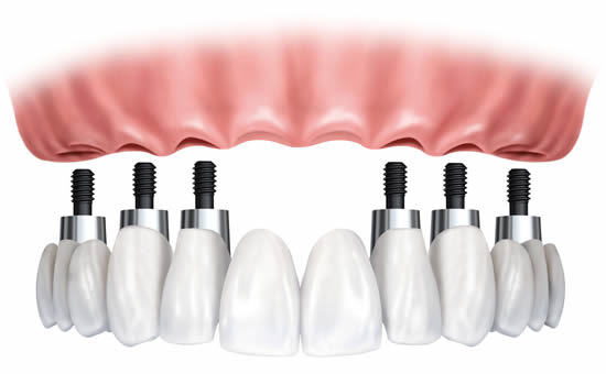 Dental implants to support a full arch of teeth