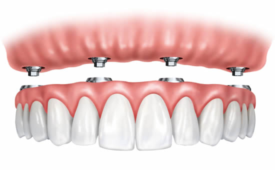 Dental implants used to support a denture